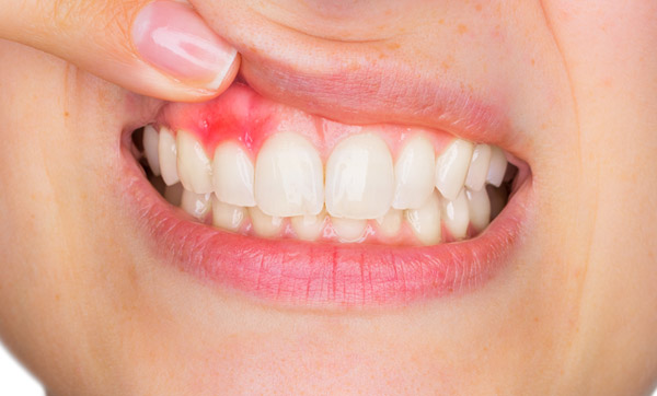 Bệnh về nướu răng có thể gặp ở người bọc răng sứ gây hôi miệng